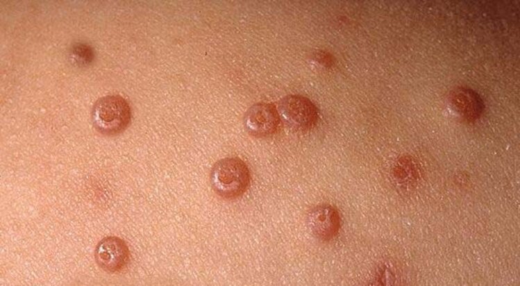 molusco contagioso | Dicas de Saúde molusco contagioso
