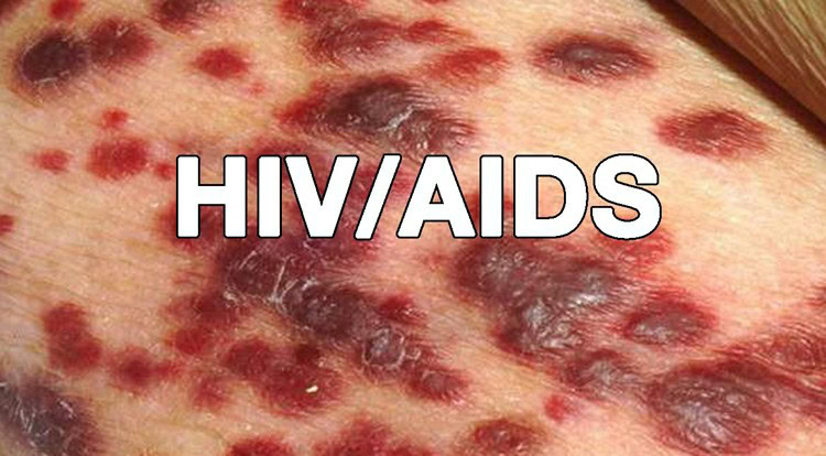 aids-2 | Dicas de Saúde aids