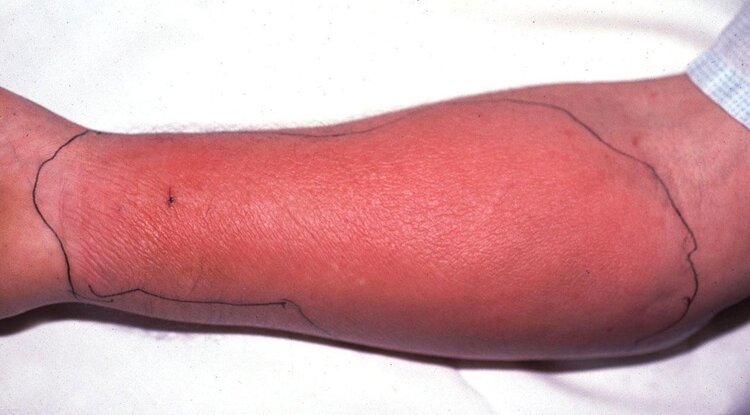 Necrotizing Fasciitis-1 | Dicas de Saúde