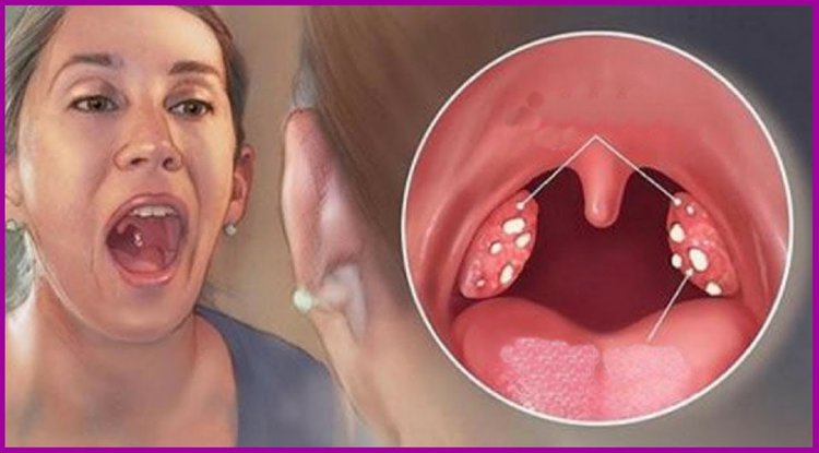 Como tirar bolinhas brancas na garganta | Dicas de Saúde Como tirar bolinhas brancas na garganta