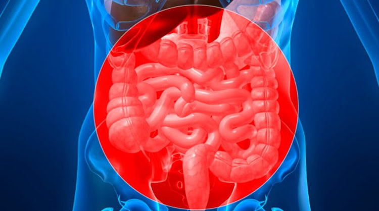 Isquemia Intestinal | Dicas de Saúde Isquemia Intestinal