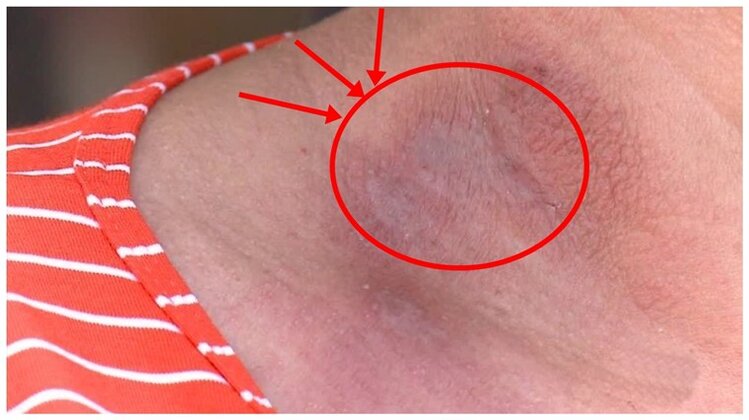 remedio caseiro para tratar queimadura de poto | Dicas de Saúde remedio caseiro para tratar queimadura de poto