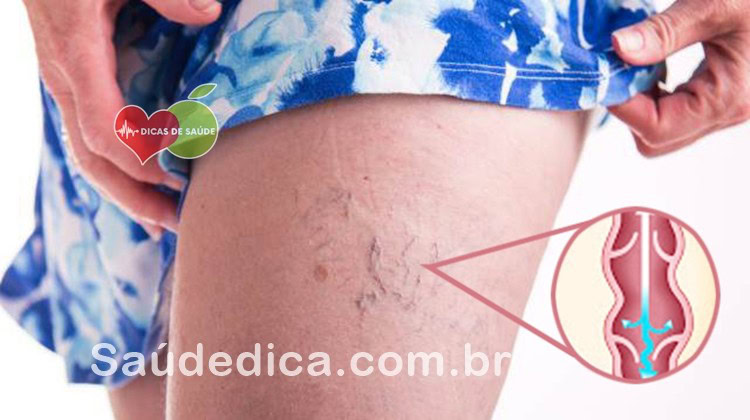 Como se livrar naturalmente das veias de aranha | Dicas de Saúde Como se livrar naturalmente das veias de aranha