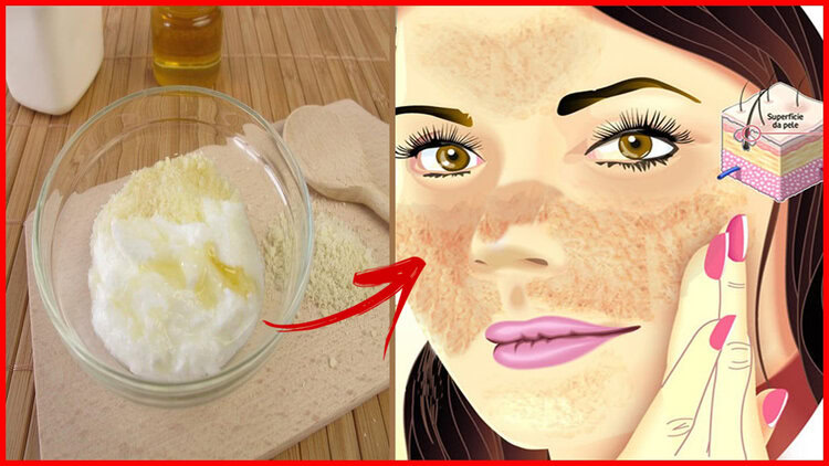 ACABE de vez com o Melasma no Rosto Usando esta receita em 7 dias! | Dicas de Saúde
