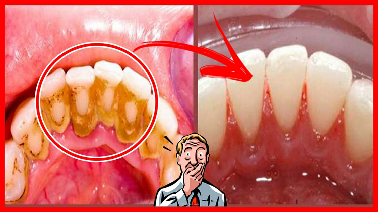 Como se Livrar do Tártaro em Menos de 30 Segundos em casa! | Dicas de Saúde