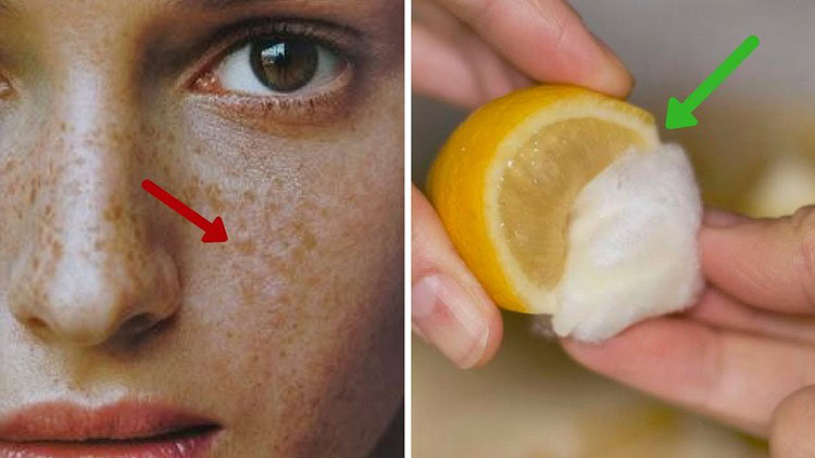 remedios caseiros para eliminar sardas | Dicas de Saúde remedios caseiros para eliminar sardas