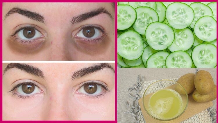 remover as olheiras | Dicas de Saúde
