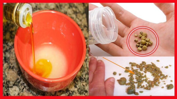 receitas para acabar com a pedras nos rins | Dicas de Saúde receitas para acabar com a pedras nos rins