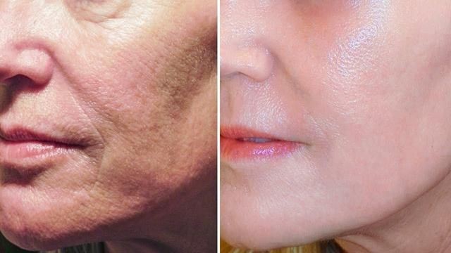 como se livrar das rugas | Dicas de Saúde como se livrar das rugas