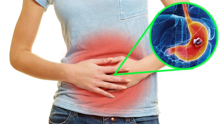 sintomas de cancer no estomago | Dicas de Saúde sintomas de cancer no estomago