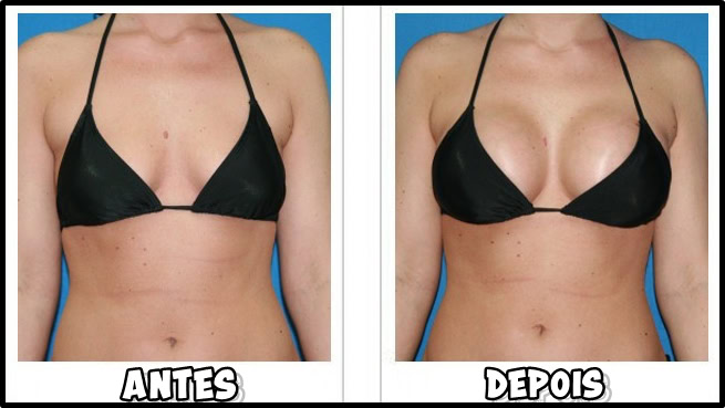 aumentar os seios naturalmente | Dicas de Saúde aumentar os seios naturalmente