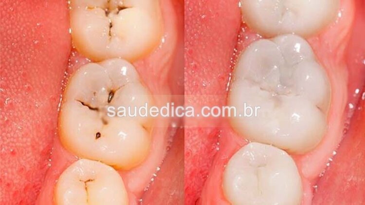 elimine a carie dentária em 5 passos sem ir ao dentista | Dicas de Saúde elimine a carie dentária em 5 passos sem ir ao dentista