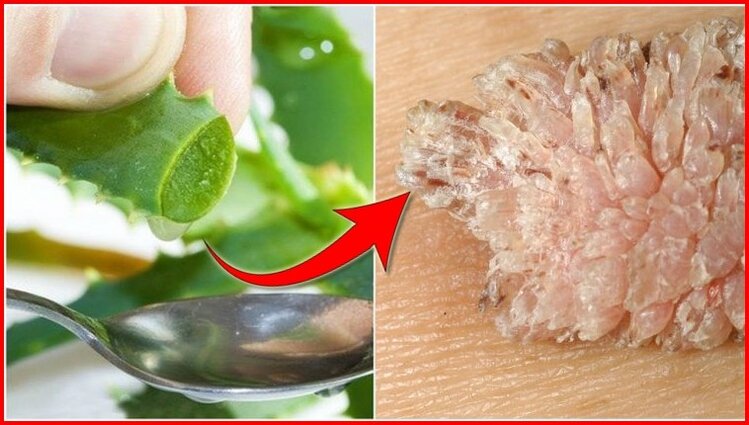 remedio natural para acabar com as verrugas | Dicas de Saúde