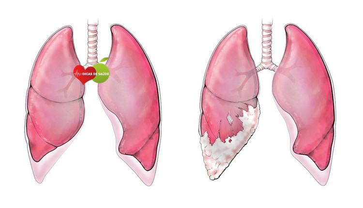 mesotelioma | Dicas de Saúde
