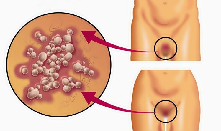 aids-3 | Dicas de Saúde