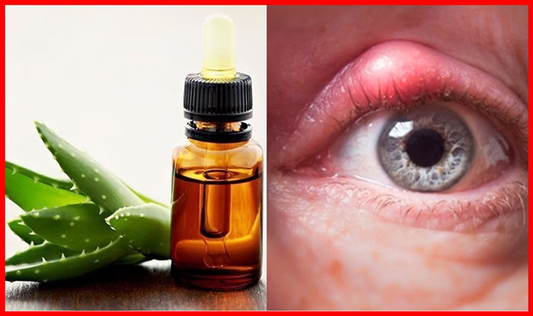 acabar com terçol | Dicas de Saúde acabar com terçol