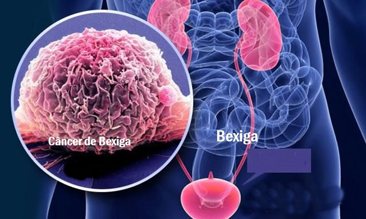 Câncer de Bexiga - Causas, Sintomas e Tratamentos 1 | Dicas de Saúde