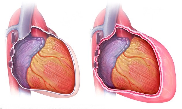 Pericardite Constrictiva jpg | Dicas de Saúde Pericardite Constrictiva