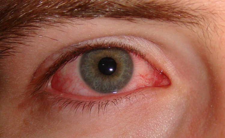 Tracoma | Dicas de Saúde