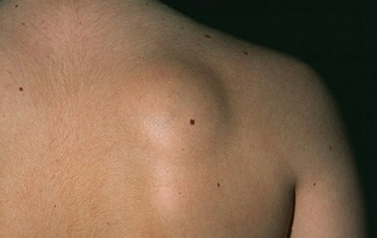 liposarcoma | Dicas de Saúde liposarcoma