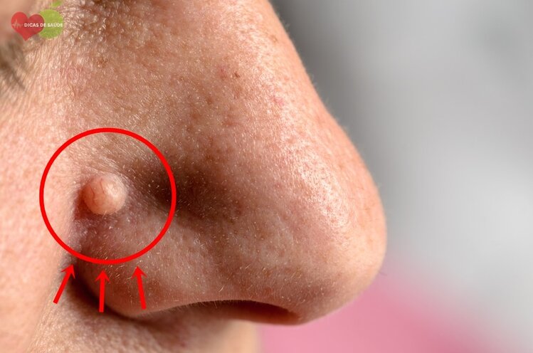 Carcinoma Basocelular - Causas, Sintomas e Tratamentos | Dicas de Saúde