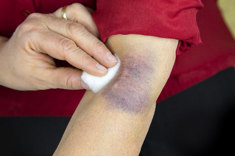 As 5 Dicas de Como Remover Hematomas Rapidamente | Dicas de Saúde