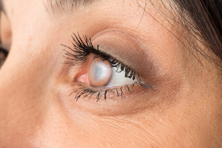 Doenças Comuns que Podem Atingir os Olhos | Dicas de Saúde