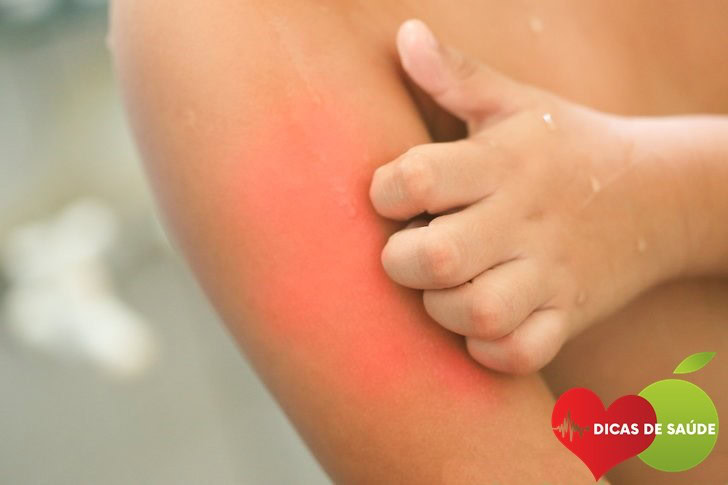 dermatite atopica-1 | Dicas de Saúde dermatite atopica-1