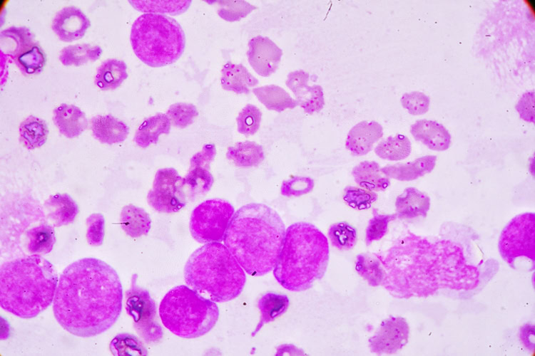 Leucemia Mieloide Aguda-1 | Dicas de Saúde