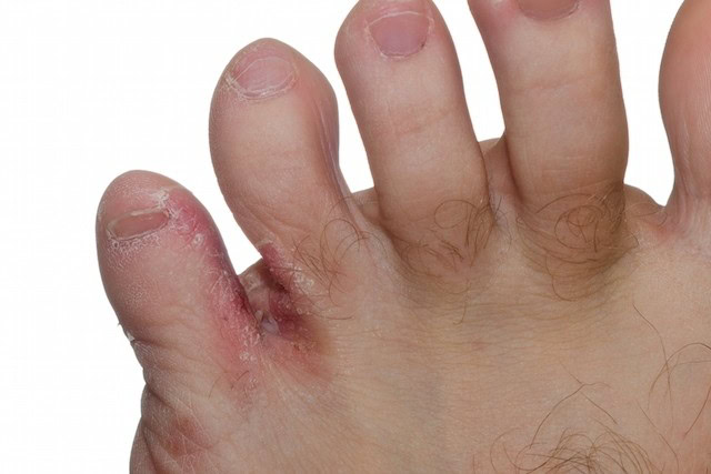 Como Acabar com a Frieira | Dicas de Saúde