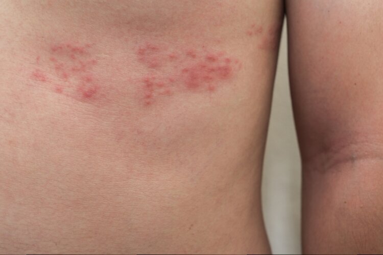Herpes Zoster | Dicas de Saúde Herpes Zoster
