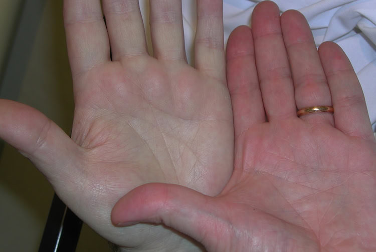 Anemia perniciosa | Dicas de Saúde