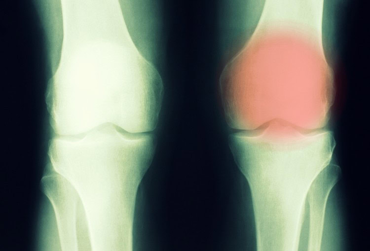 cancer de osso o que e | Dicas de Saúde cancer de osso o que e