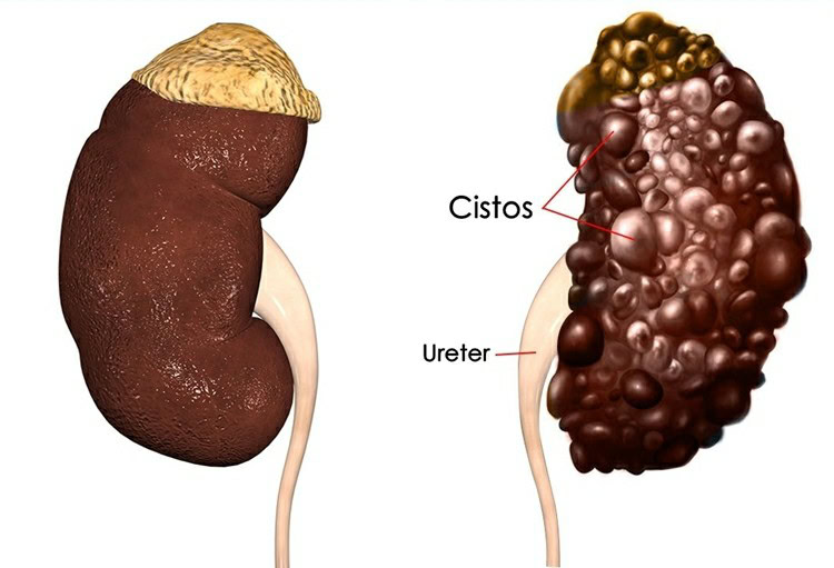 Cistos de Rim | Dicas de Saúde