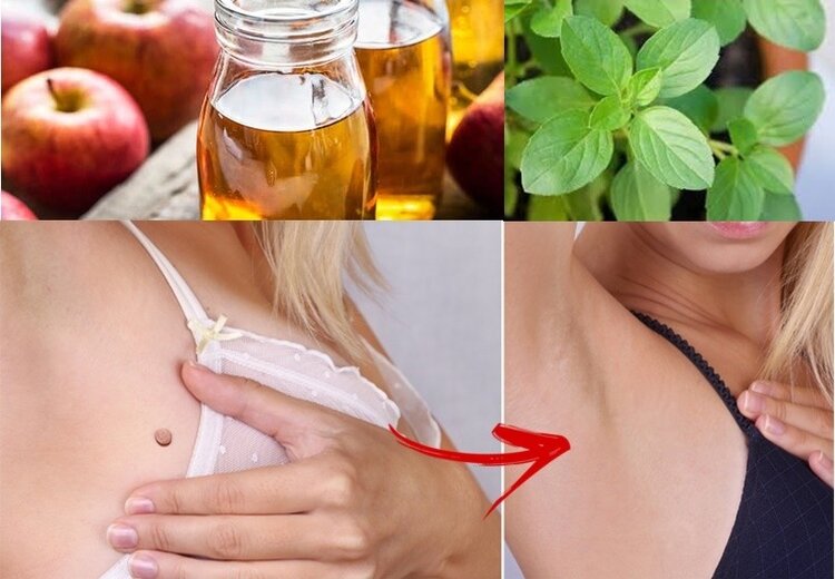eliminar verrugas | Dicas de Saúde eliminar verrugas