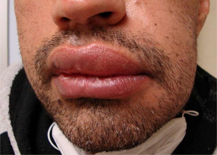 Angioedema Angioedema