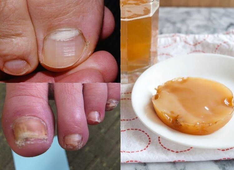 vinagre para eliminar fungos das unhas | Dicas de Saúde vinagre para eliminar fungos das unhas