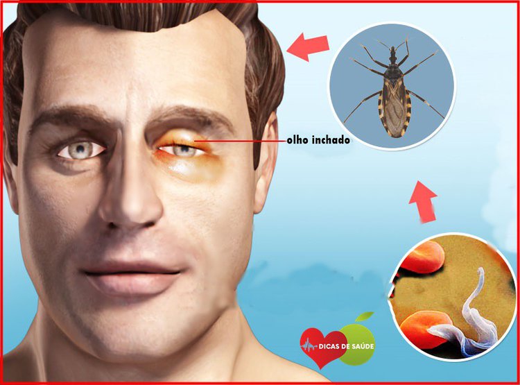 doença de chagas-1 | Dicas de Saúde