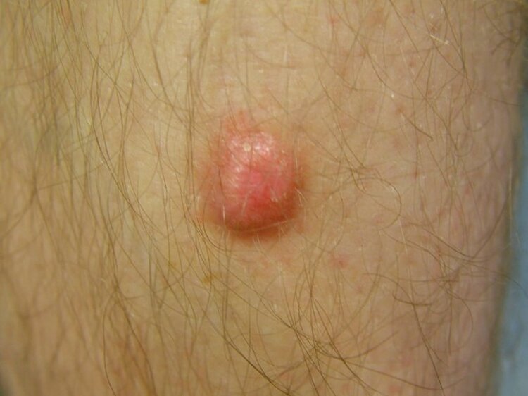 Dermatofibroma | Dicas de Saúde