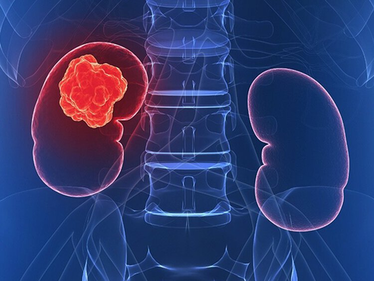 Principais Estágios do Tumor de Wilms | Dicas de Saúde