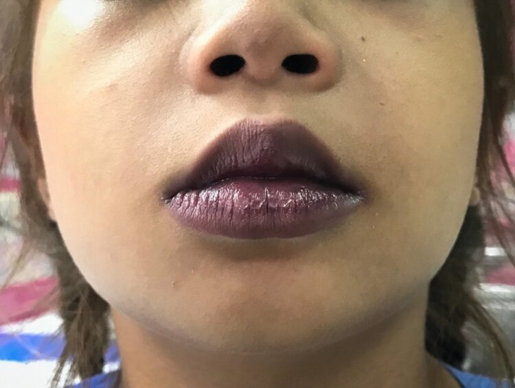 coronavirus causa labios roxos | Dicas de Saúde