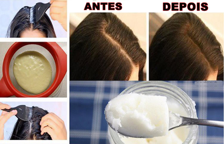 perda de cabelo | Dicas de Saúde perda de cabelo