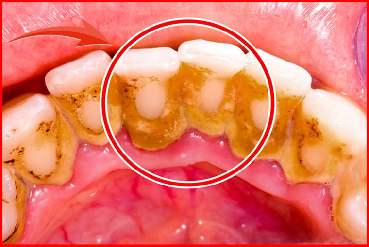 Truques para Remover a Placa bacteriana em 5 minutos | Dicas de Saúde