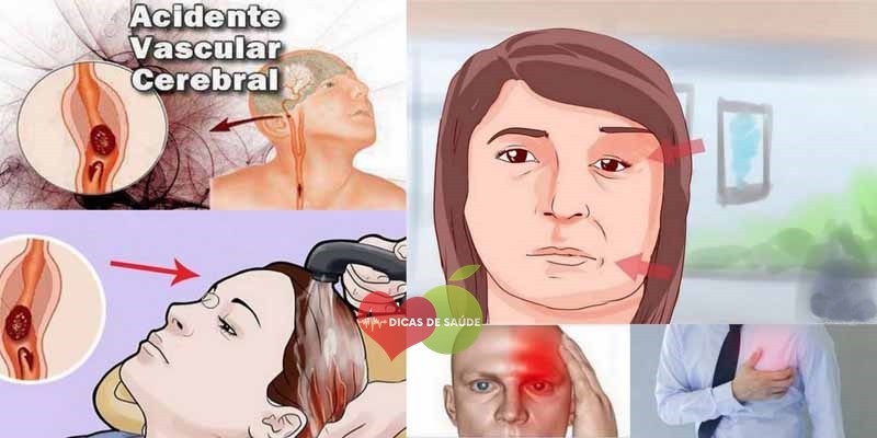 sintomas de avc | Dicas de Saúde