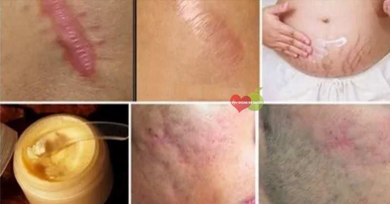 Elimine Cicatrizes de Qualquer Parte do Corpo em Menos de Um Mês | Dicas de Saúde Elimine Cicatrizes de Qualquer Parte do Corpo em Menos de Um Mês