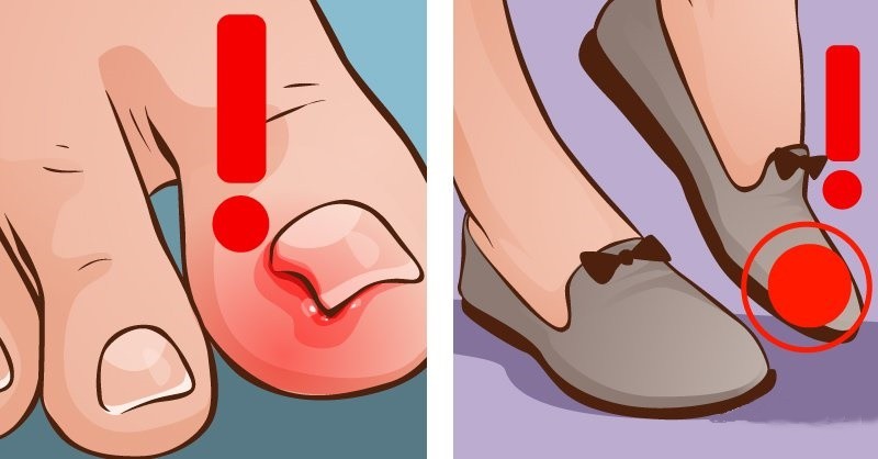 dicas de como eliminar as unhas encravadas | Dicas de Saúde dicas de como eliminar as unhas encravadas