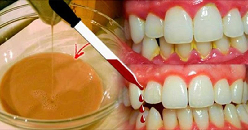 receita caseira para eliminar tartaro | Dicas de Saúde receita caseira para eliminar tartaro