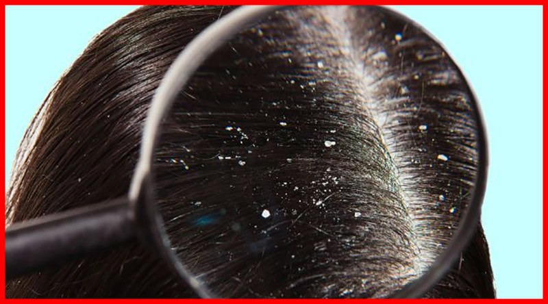 cabelo com caspa | Dicas de Saúde