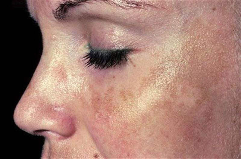 remedio caseiro para eliminar manchas do rosto | Dicas de Saúde remedio caseiro para eliminar manchas do rosto