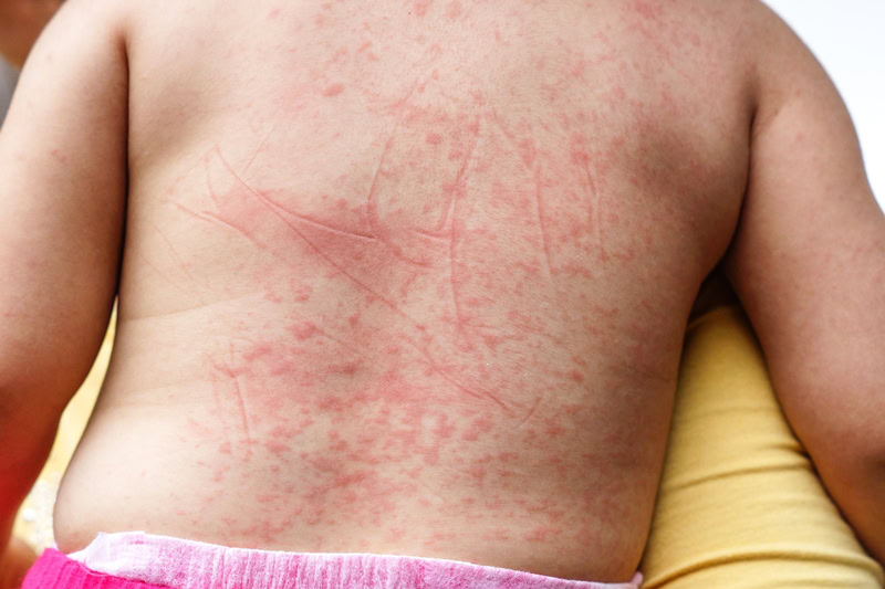 Acrodermatite | Dicas de Saúde Acrodermatite